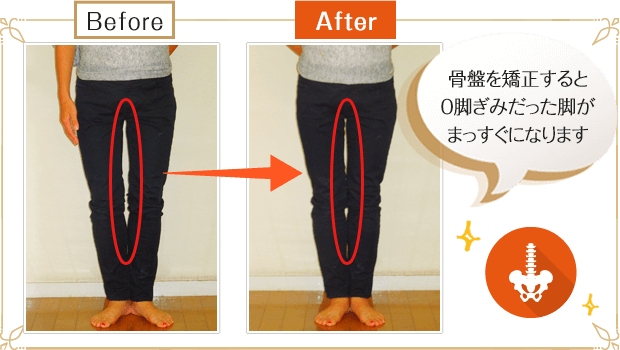 骨盤を矯正するとO脚ぎみだった脚がまっすぐになります